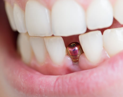 Implantate-Kieferorthopaedie.jpg