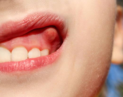 Entzündungen im Mund-, Kiefer- und Gesichtsbereich